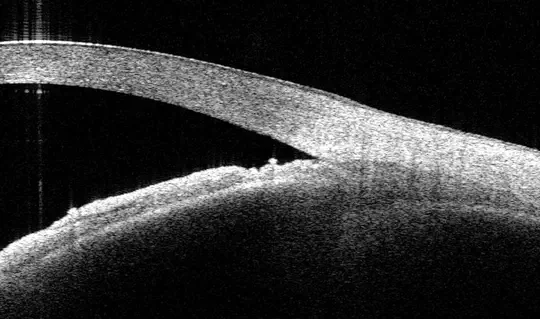 Anatomy and biomechanics of the anterior segment