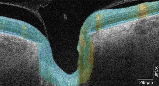 Optic nerve head biomechanics